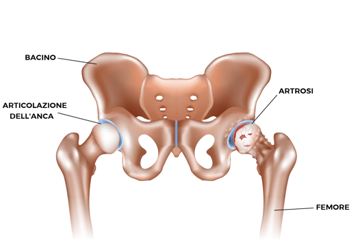 Articolazione coxo-femorale 