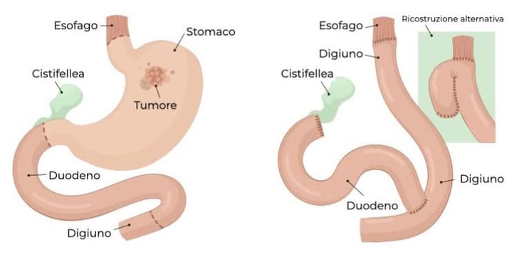 illustrazione prima e dopo la gastrectomia totale
