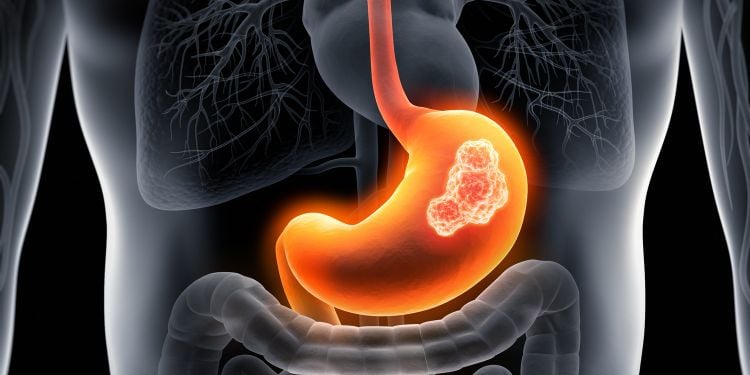 Tipi di tumore allo stomaco - adenocarcinoma gastrico