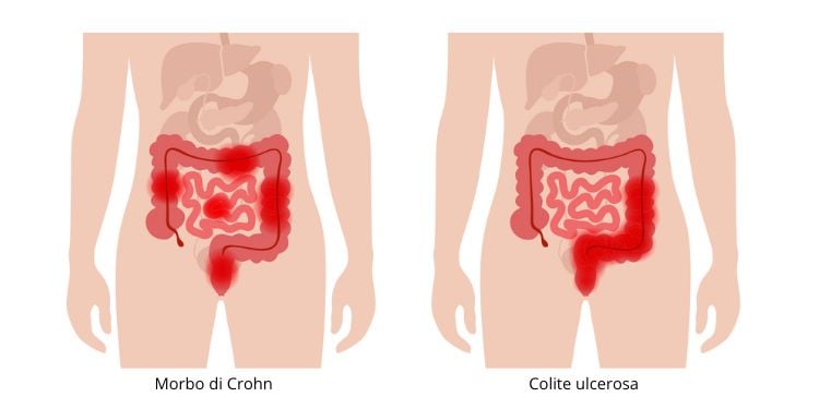 Rappresentazione di ulcerosa e Morbo di Crohn, possibili cause del tumore al colon