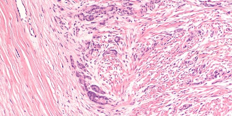 Fotomicrografia cancro allo stomaco adenocarcinoma gastrico stadio patologico T2